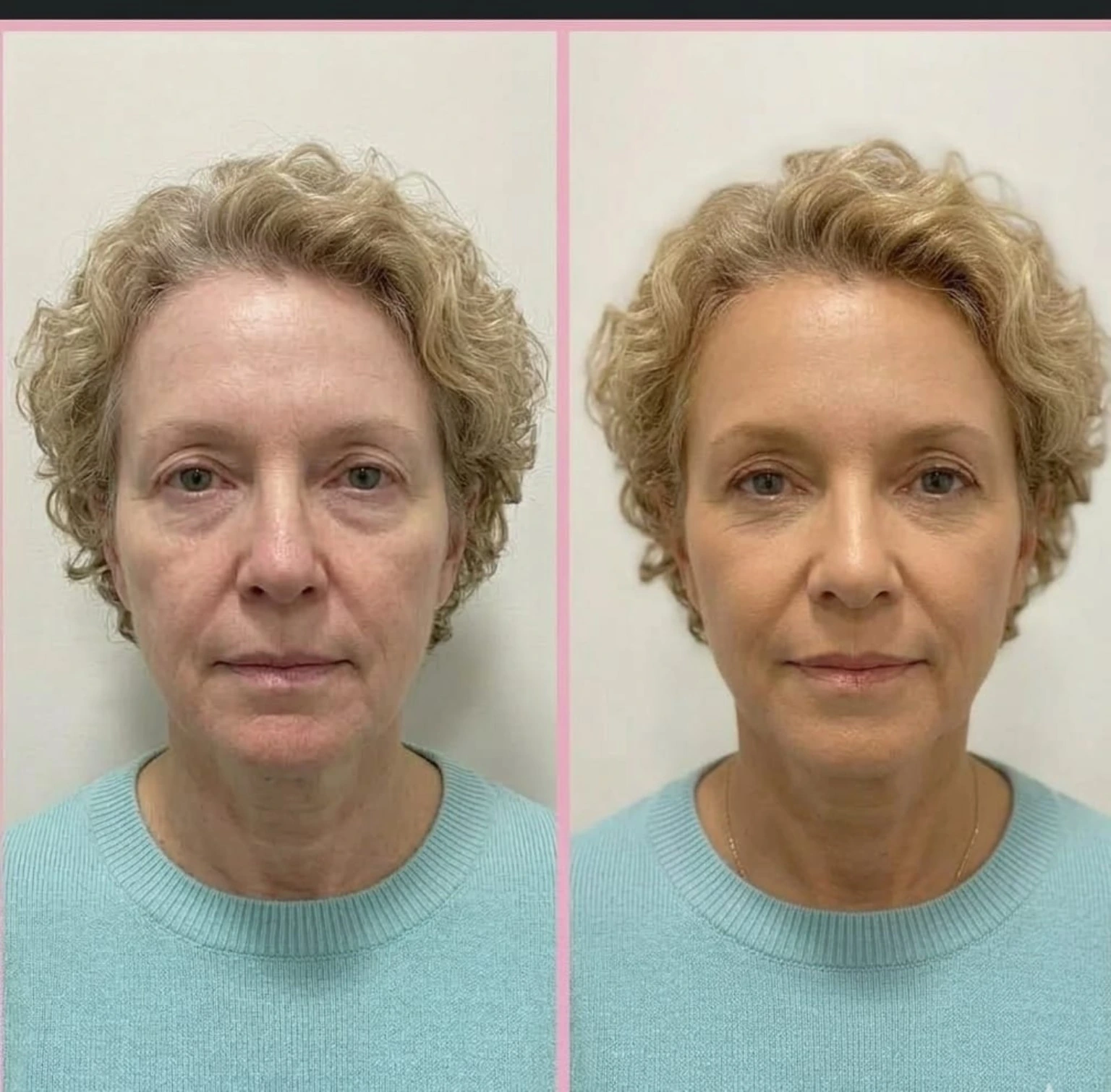 Antes y después facial de un bronceado natural